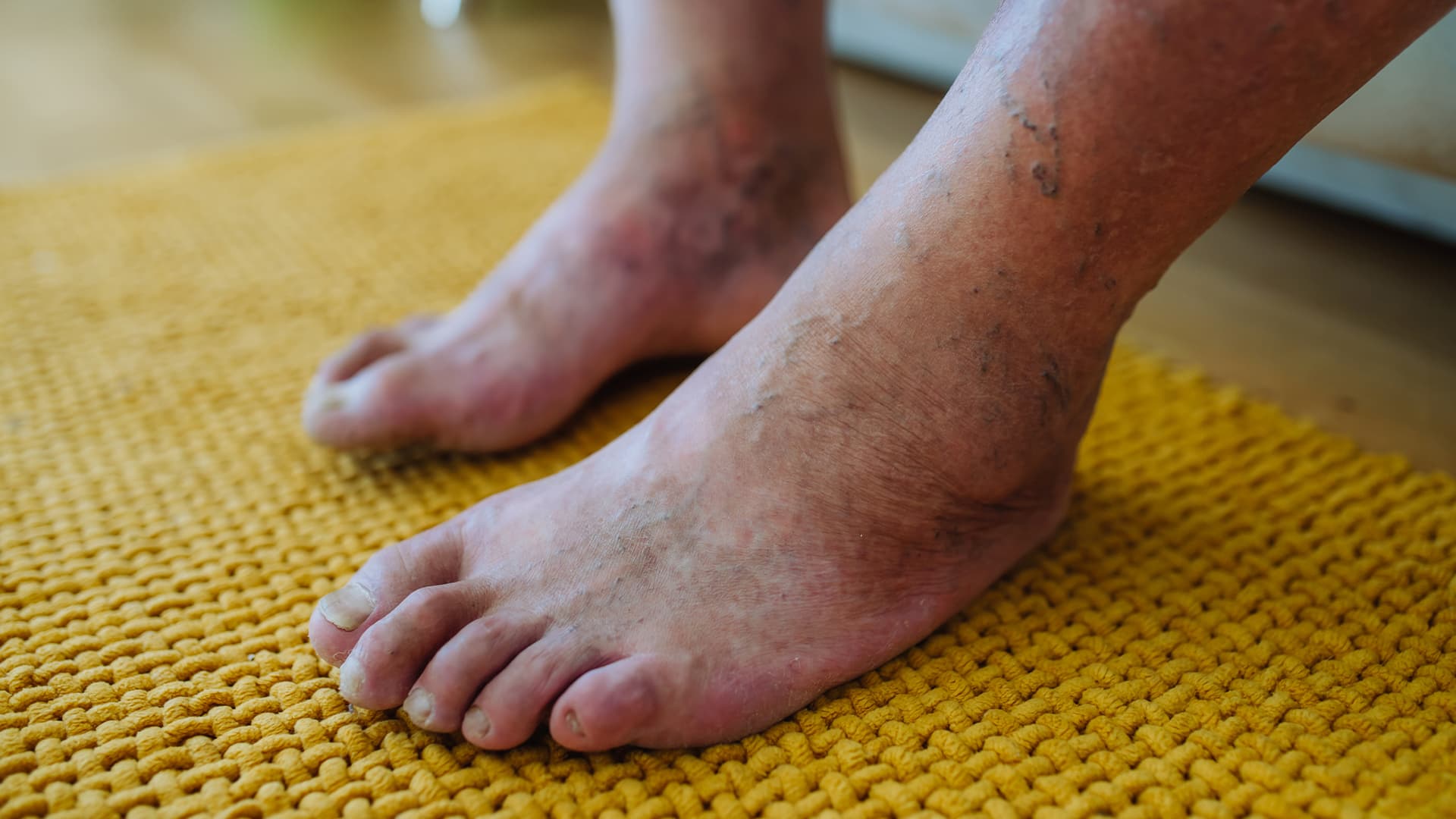 Managing Diabetic Foot Health