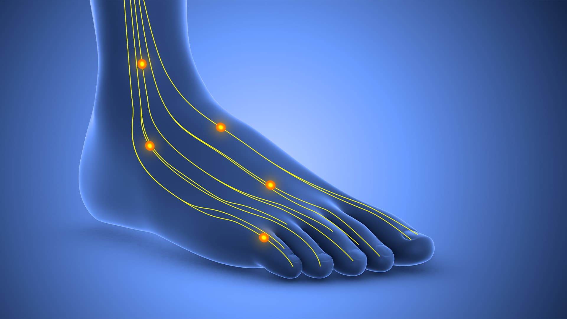 Neuromas (Morton’s Neuroma)